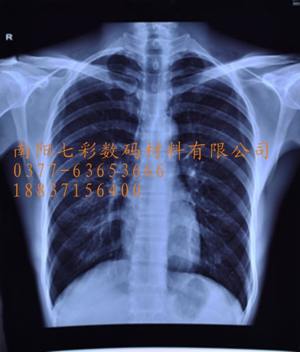 兰州医用激光胶片酒泉医用蓝基白基X线B超喷墨胶片